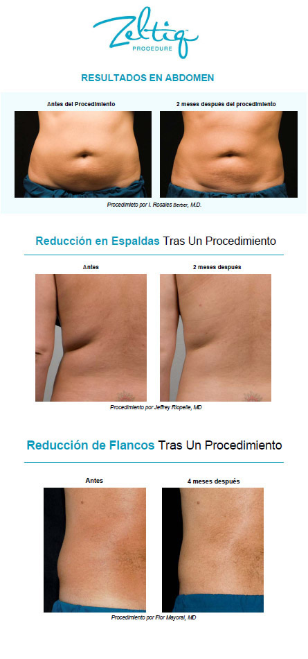 Criolipolisis
